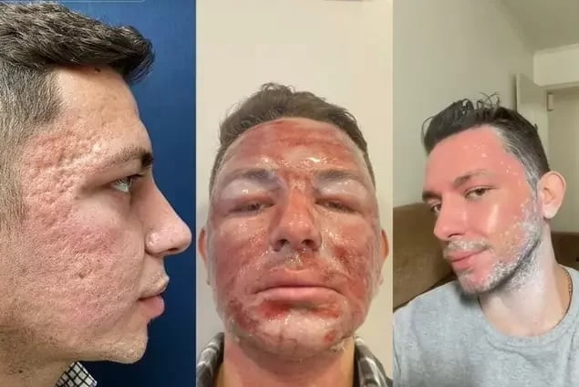 Peeling De Fenol Homem Viraliza Com V Deo Antes E Depois