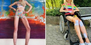 "Cirurgia de Frankenstein": Uma modelo alemã pagou quase 300 mil euros (R$1,7 milhão, aproximadamente) em uma cirurgia de alongamento ósseo.