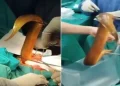 enguia sendo retirada em cirurgia