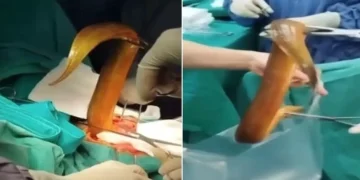enguia sendo retirada em cirurgia