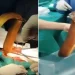 enguia sendo retirada em cirurgia