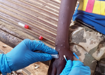 Mpox