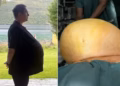 Homem recebe tratamento com Ozempic para obesidade e diabetes, mas descobre que tinha na verdade um tumor de 27kg na barriga