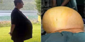 Homem recebe tratamento com Ozempic para obesidade e diabetes, mas descobre que tinha na verdade um tumor de 27kg na barriga
