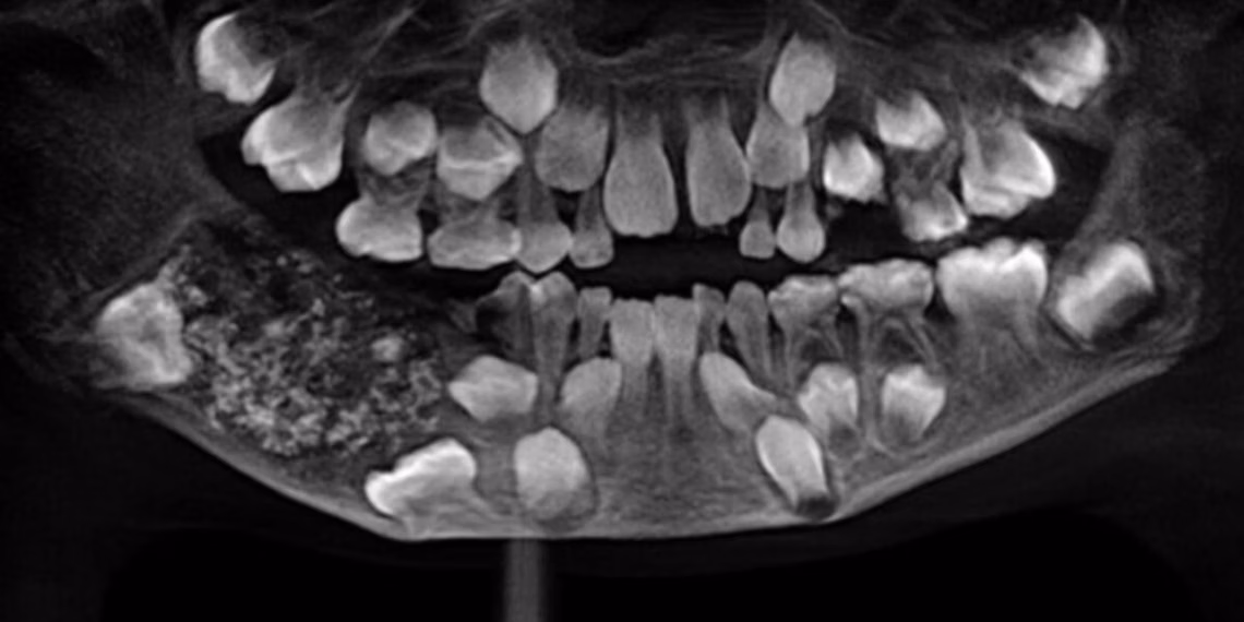 dentes