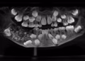 dentes