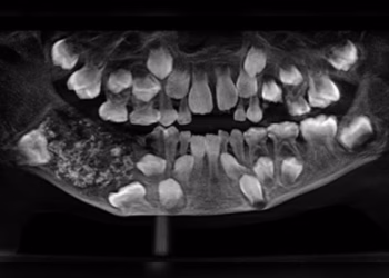 dentes