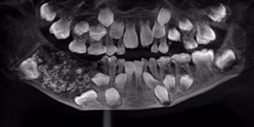 dentes