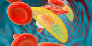 toxoplamose