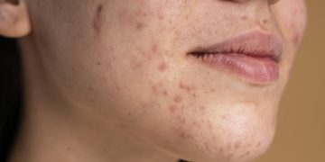 O corpo manda sinais antes do colapso: entenda os sintomas da inflamação crônica
