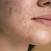 O corpo manda sinais antes do colapso: entenda os sintomas da inflamação crônica